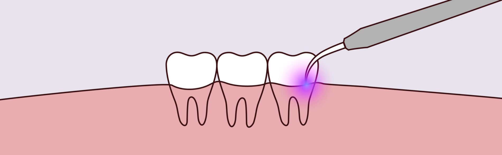 Laser Therapy - Dovey Dental - Dovey Dental -