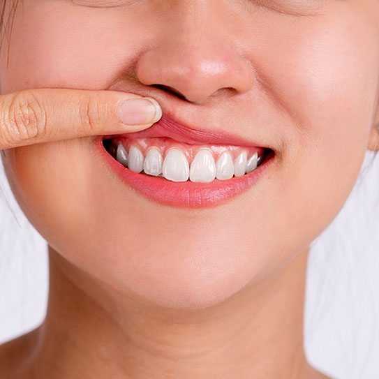 How Can I Defend Against Gum Recession? - Dovey Dental - Dovey Dental -