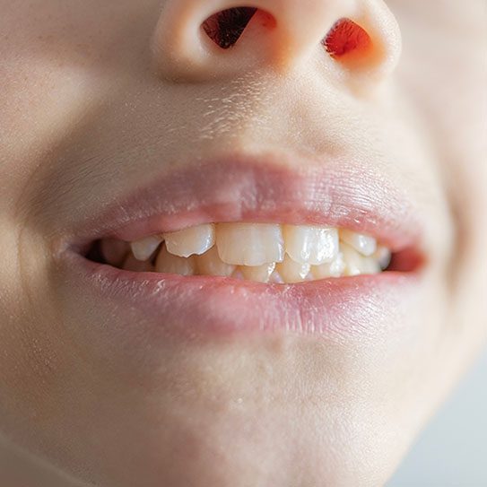 Gum Disease Can Affect Kids Too - Dovey Dental - Dovey Dental -