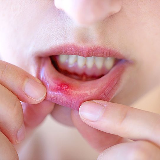 Canker Sores: Prevention, Causes, and Treatment - Dovey Dental - Dovey Dental -