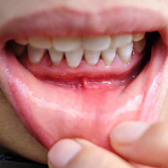 Gum Recession: Causes, Prevention, and Treatment - Dovey Dental - Dovey Dental -